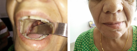 Cancer Of Buccal Mucosa